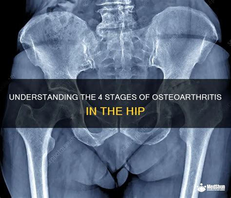 hip pain aberdeen|Hip Osteoarthritis: The Four Stages .